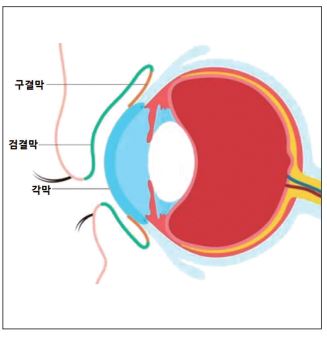 염증 원인 따라 감염성과 비감염성 구분
