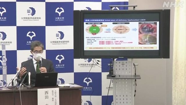 iPS각막 이식 후 안정성과 유효성을 보여주는 결과가 제시되었다고 발표하는 오사카 대학의 니시다 교수(사진 출처 - NHK 캡처)