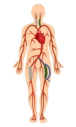 ▲인조혈관 경유 타비시술을 받은 환자의 혈관 상태. 우측 대퇴동맥과 우측 경동맥에 스텐트가 삽입돼 있고, 좌측 대퇴동맥과 좌측 경동맥은 심한 협착으로 폐쇄된 상태. 좌측 대퇴동맥에 연결된 인조혈관을 경유해 타비시술이 이뤄짐