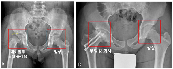 ▲우측 고관절에 대퇴골두 골단 분리증 및 무혈성 괴사가 발생한 소아청소년 환자의 X-ray