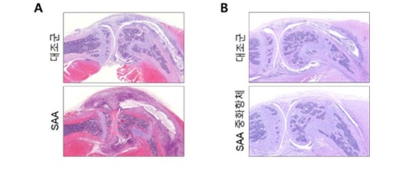 [자료 1] 생쥐에서 혈청 아밀로이드 A(Serum Amyloid A, SAA)를 관절 내로 주사하거나 SAA 유전자를 간에 과발현 할 경우, 만성 관절염이 현저히 나빠지지만(왼쪽), SAA를 억제하는 항체로 치료할 경우 관절염이 호전됨을 보여 줌(오른쪽)